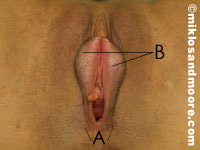 Before (A) Labia majora posterior divergence 