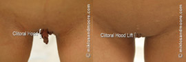 Clitoral Hood Lift - Before and After