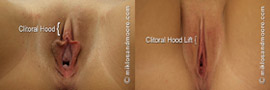 Clitoral Hood Lift - Before and After