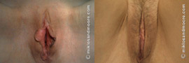 Labia Minora Reduction - Before and After