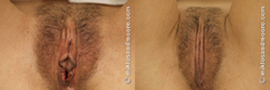Vaginal Rejuvenation Before and After Gallery