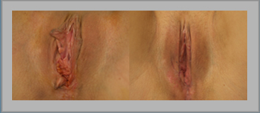 Labia Revisions and Restoration (botched)
