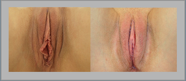 Clitoral Hood Reduction Before and After