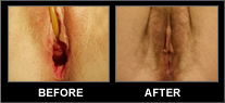 Gaping Introitus Before and After Pictures