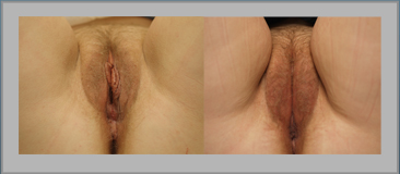 Labia Majora Convergence Before and After Gallery