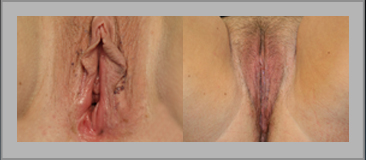 Labia Minora Reduction Before and After Gallery