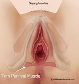 Before – Gaping Introitus or Enlarged Vaginal Opening
